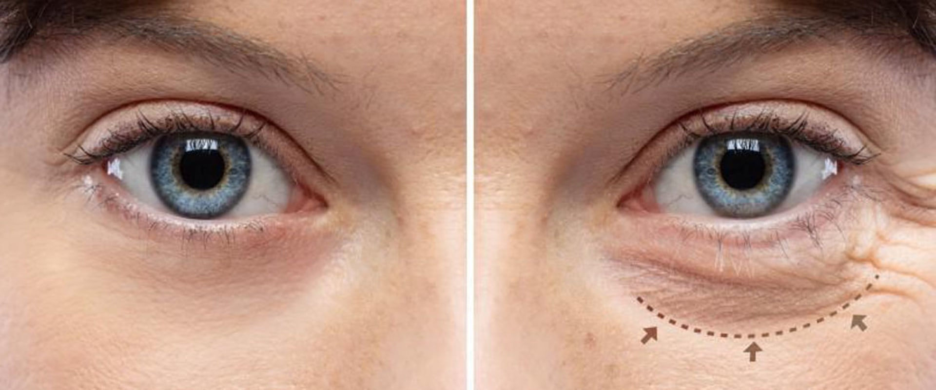I benefici a lungo termine del trattamento del contorno occhi
