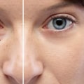 I benefici a lungo termine del trattamento del contorno occhi